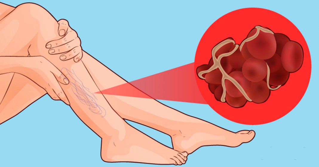 Coágulo de sangue na perna: 4 sintomas para prestar atenção, e como saber quando é uma emergência