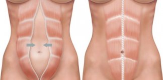 Diástase abdominal: o que é e como combatê-la?