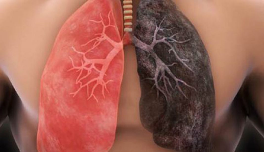Os pulmões se regeneram se você parar de fumar. Descoberto células especiais que ‘substituem’ as mutadas