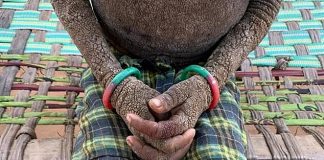 Difícil se mexer: doença rara faz pele de menina virar “pedra”