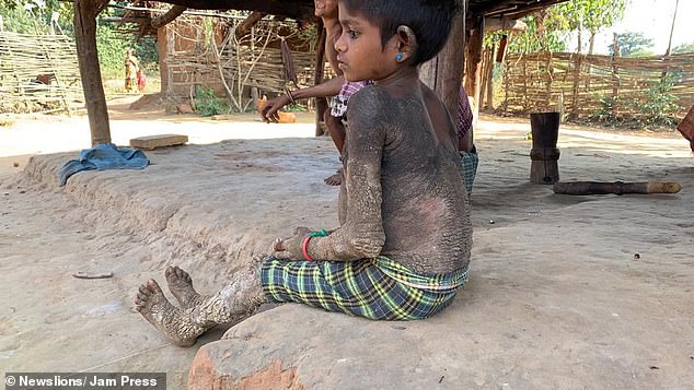 revistasaberesaude.com - Difícil se mexer: doença rara faz pele de menina virar "pedra"