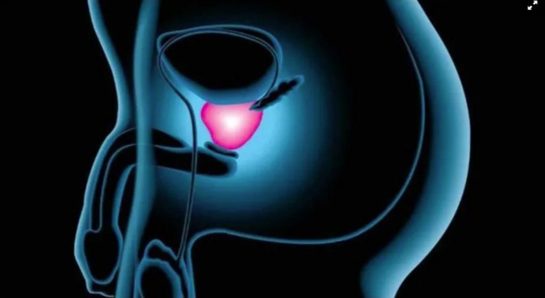 Novo biomarcador prevê diagnóstico rápido para câncer de próstata