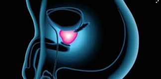 Novo biomarcador prevê diagnóstico rápido para câncer de próstata