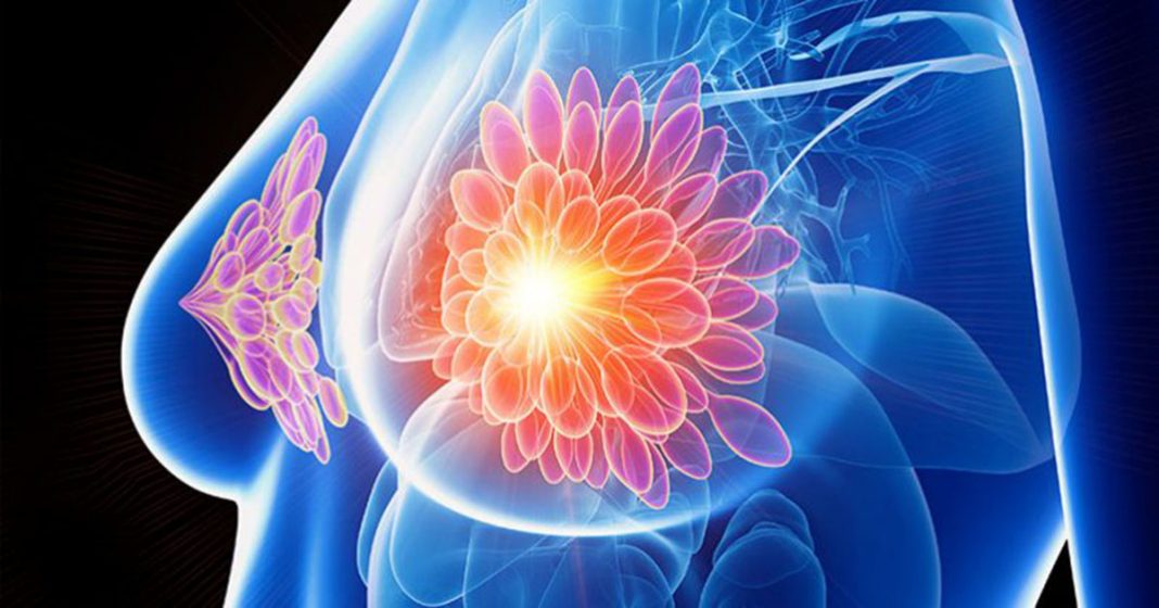 Cientistas em Amsterdã destruíram tumores de câncer de mama em 11 dias sem quimioterapia