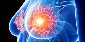 Cientistas em Amsterdã destruíram tumores de câncer de mama em 11 dias sem quimioterapia