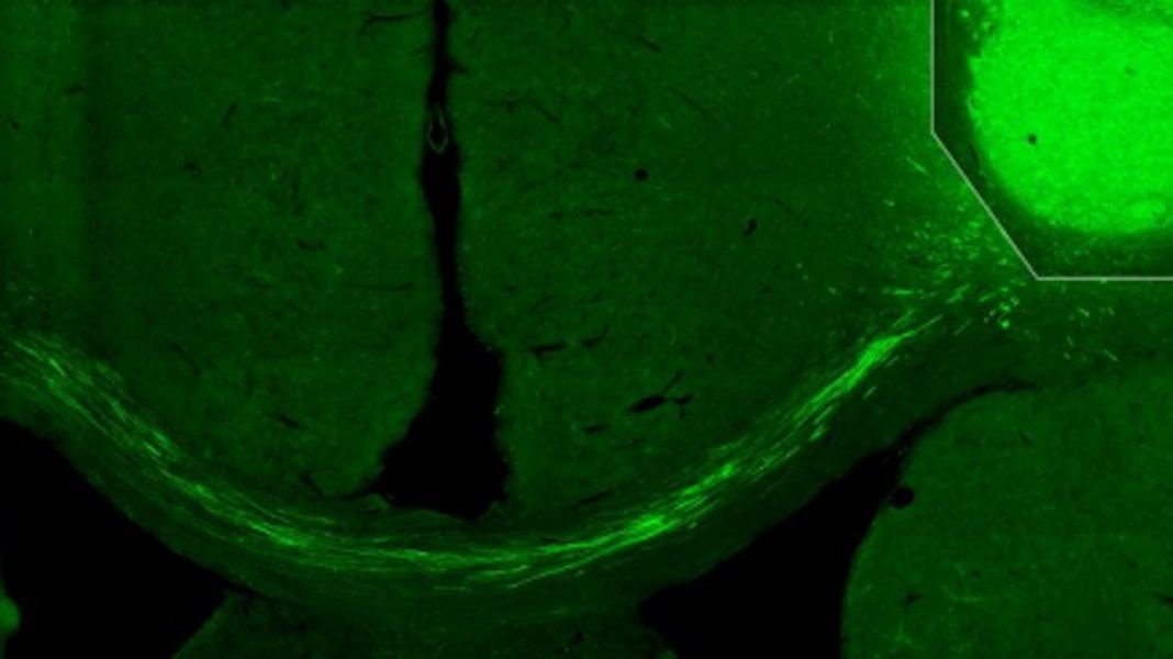 Neurobiologistas conseguiram reverter os danos por acidente vascular cerebral usando células da pele humana
