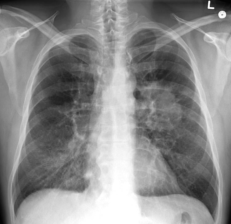 Lung Cancer X Ray CC James Heilman MD via Wikipedia Commons  - Tratamento médico revolucionário em Israel: um pulmão foi removido do corpo de um paciente com câncer, limpo e devolvido