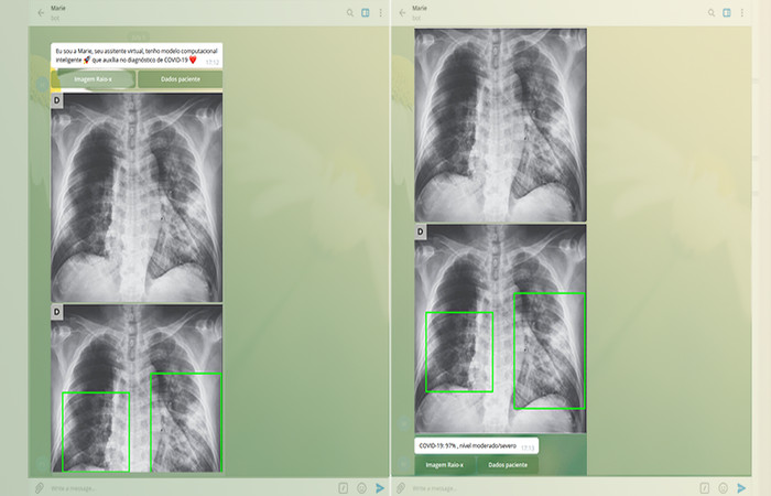 Aplicativo criado na USP faz o diagnóstico da covid-19 a partir de radiografia do pulmão revistasaberesaude.com - Aplicativo criado na USP faz o diagnóstico da covid-19 a partir de radiografia do pulmão