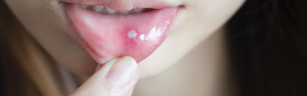 Como você pode tratar aftas e úlceras na boca
