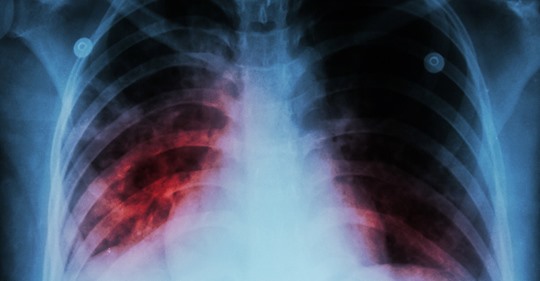 Aplicativo criado na USP faz o diagnóstico da covid-19 a partir de radiografia do pulmão