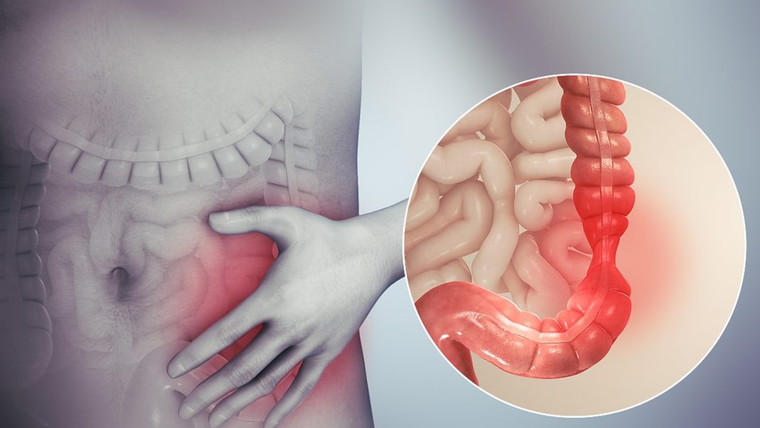 Bactérias da boca têm sido associadas a formas graves de doença inflamatória intestinal