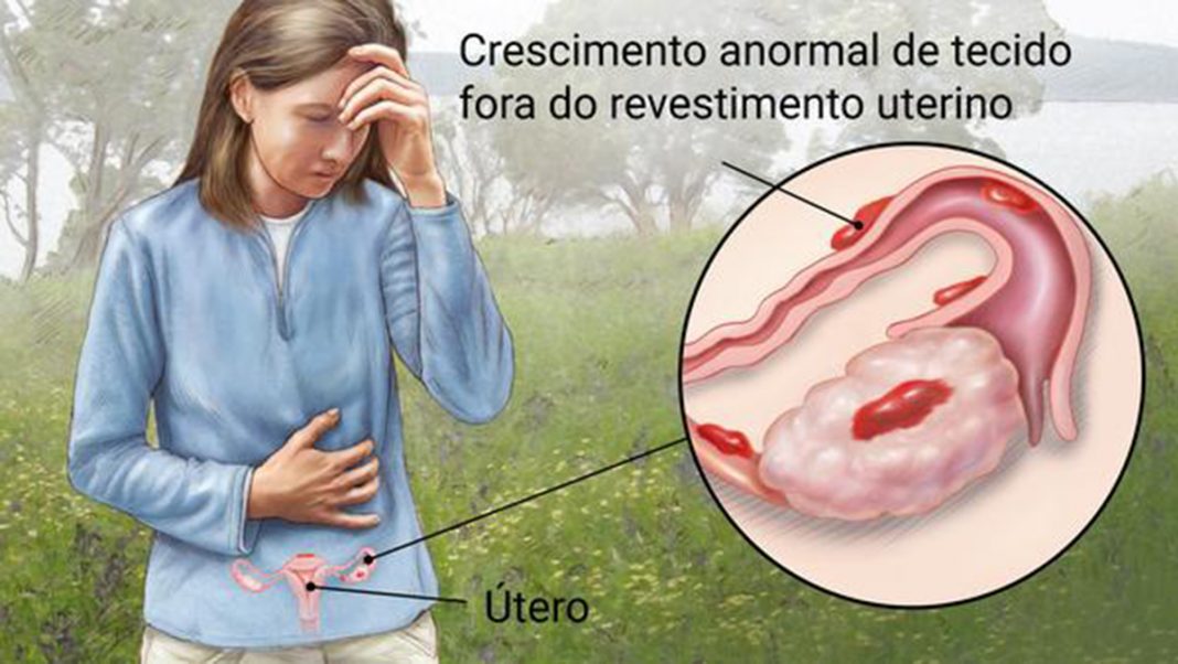 Tratamento para endometriose com nanotecnologia pode aliviar muito a dor em mulheres que sofrem com o problema