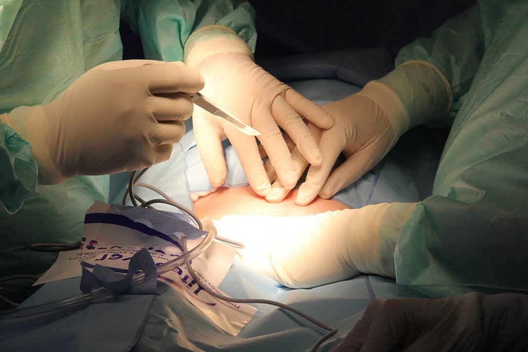 Antibióticos podem substituir ou retardar a cirurgia para apendicite em adultos