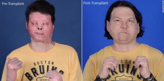 Médicos dos EUA realizaram o primeiro transplante de rosto e mãos bem-sucedido do mundo