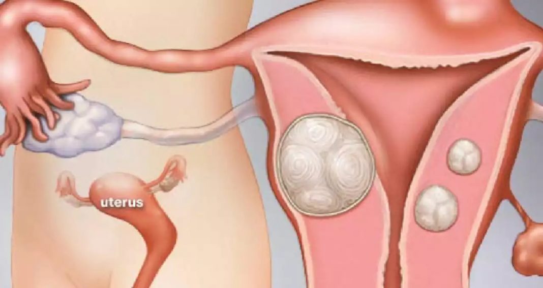 Nova combinação de medicamentos pode ajudar a tratar miomas uterinos