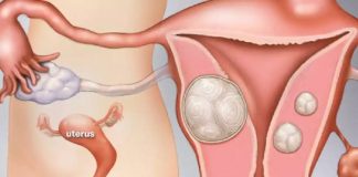 Nova combinação de medicamentos pode ajudar a tratar miomas uterinos