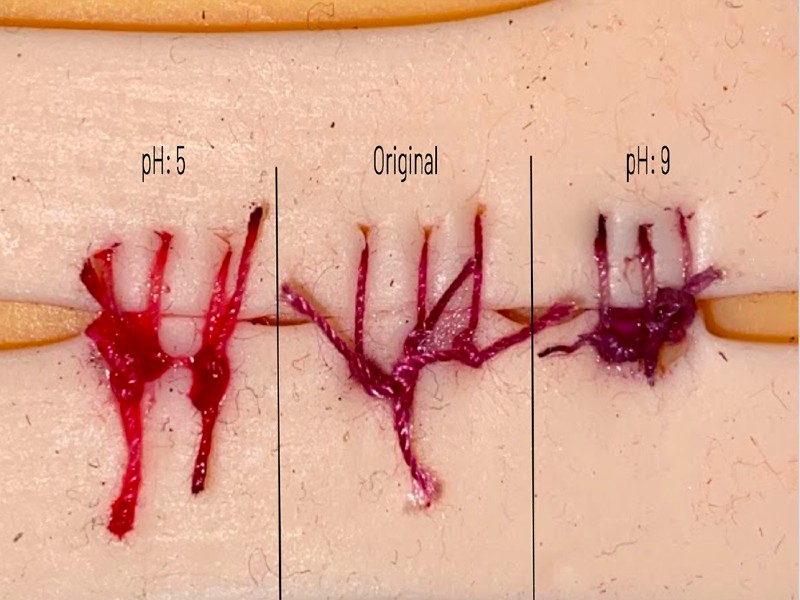 revistasaberesaude.com - Estudante cria sutura de beterraba que alerta sobre infecção