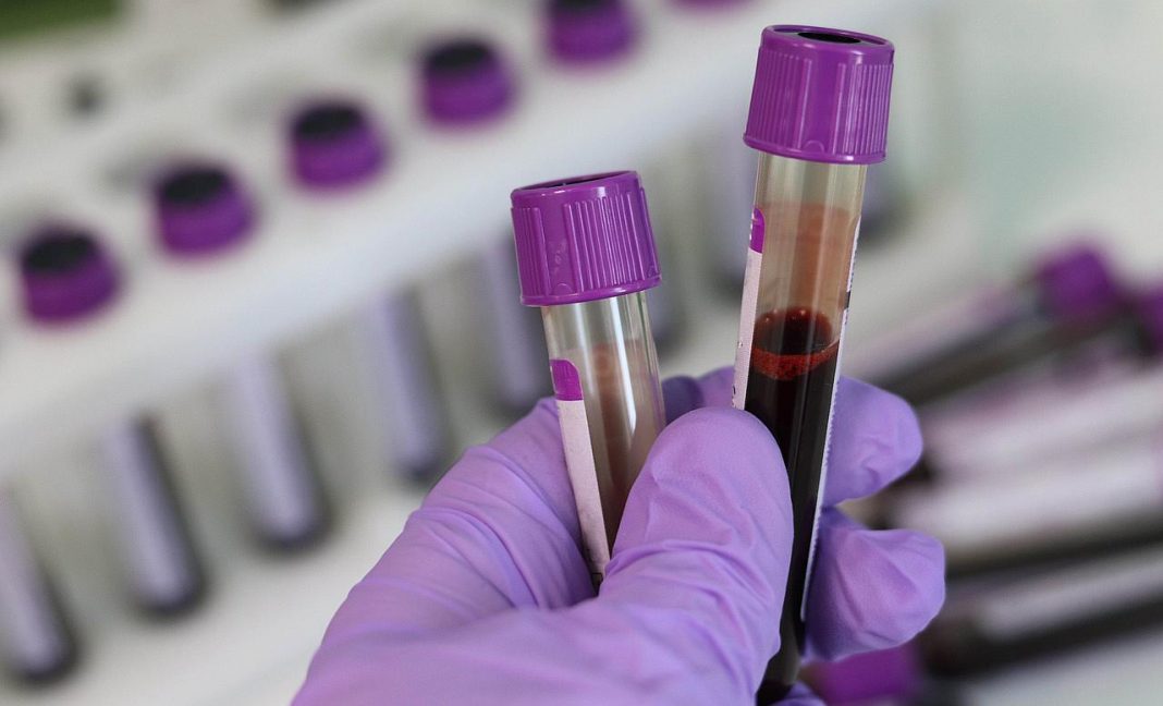 Cientistas desenvolvem novo exame de sangue que pode diagnosticar seu nível de depressão