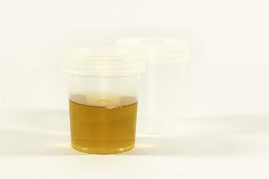 Médicos relatam caso extremamente raro de uma pessoa que urina álcool