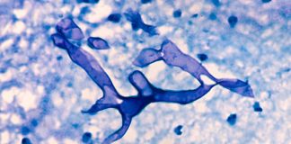 Infecção rara por fungos está “mutilando” pacientes curados da Covid-19 na Índia