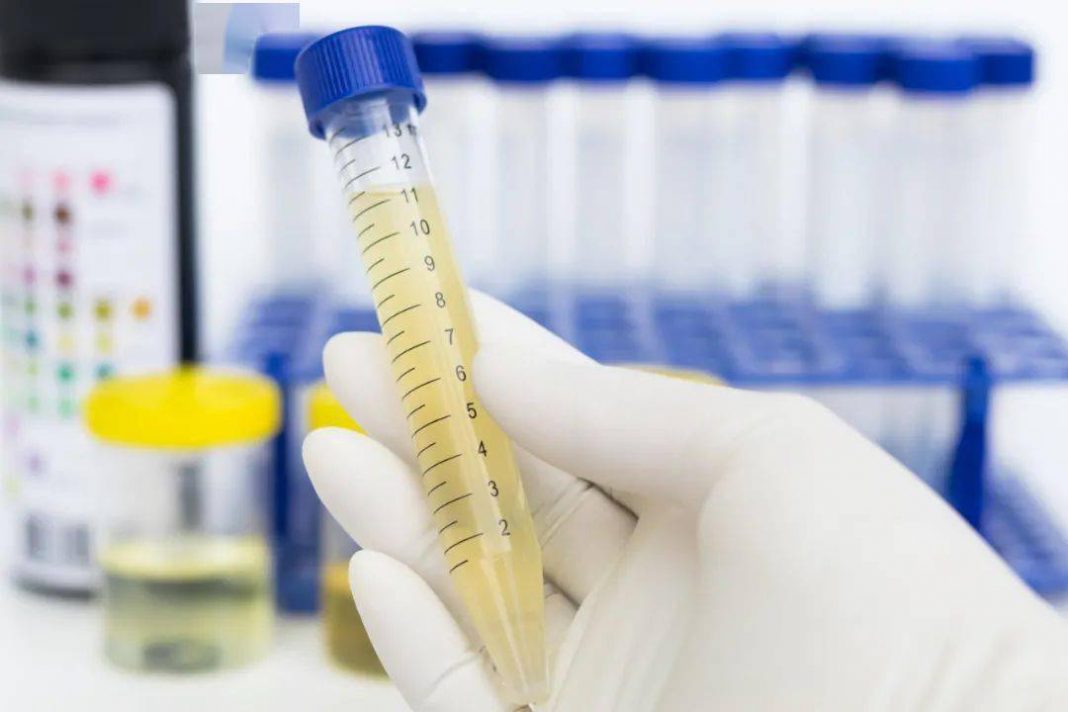 Teste de urina detecta tumores cerebrais com alto grau de precisão