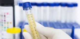 Teste de urina detecta tumores cerebrais com alto grau de precisão