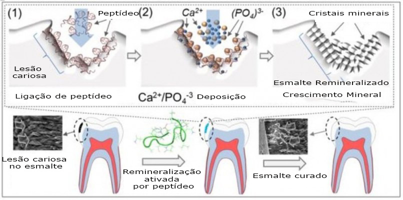 revistasaberesaude.com - Tratamento dentário engenhosamente simples pode curar cáries dentárias sem qualquer obturação