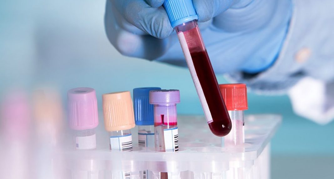 Exame de sangue pode detectar câncer anos antes