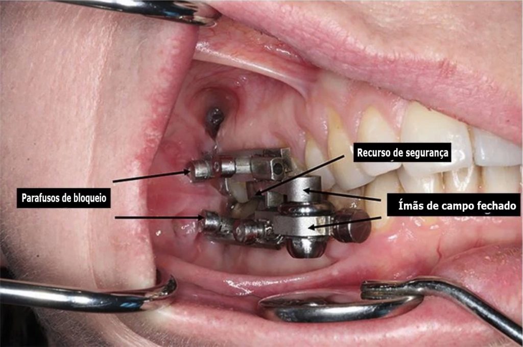 revistasaberesaude.com - Dispositivo de perda de peso literalmente trava sua boca fechada