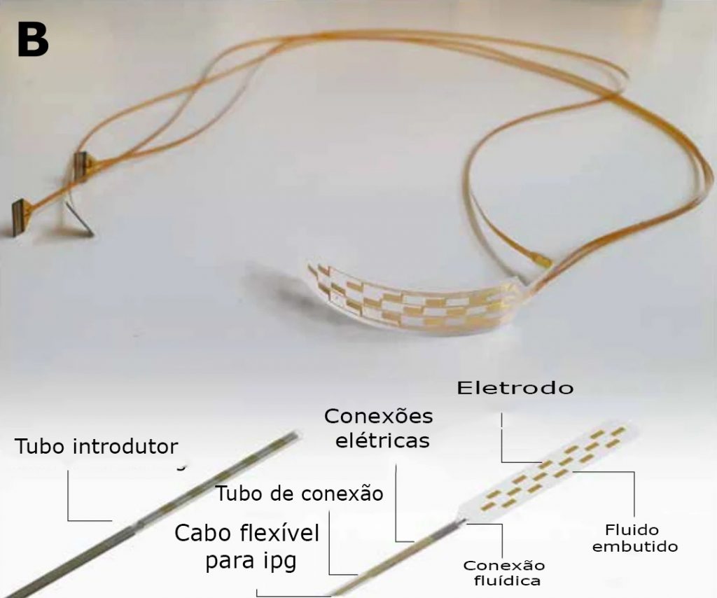 Implante de medula espinhal "inflável" inovador pode tornar o alívio da dor amplamente disponível revistasaberesaude.com - Implante de medula espinhal "inflável" inovador pode tornar o alívio da dor amplamente disponível