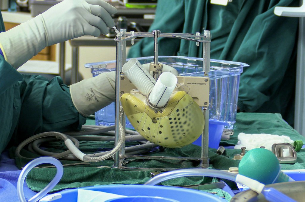 Homem de 39 anos torna-se o primeiro paciente a receber implante cardíaco artificial