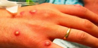 Varíola de macacos: doença contagiosa rara gera alerta nos EUA