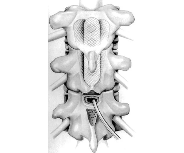 revistasaberesaude.com - Implante de medula espinhal "inflável" inovador pode tornar o alívio da dor amplamente disponível