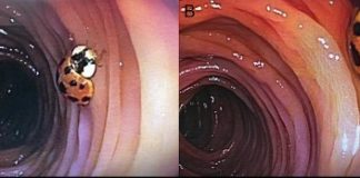 Um homem descobre que tem uma joaninha vivendo em seu intestino após uma colonoscopia