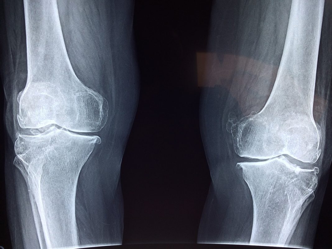 Um hidrogel injetável para regenerar a cartilagem danificada nas articulações