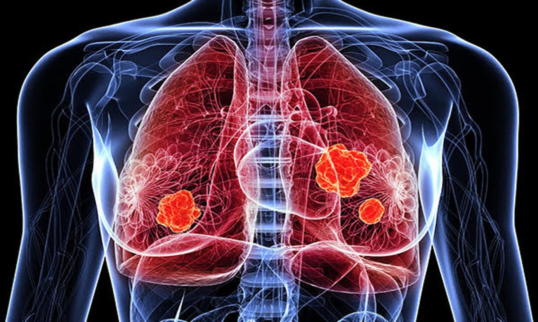 Câncer de pulmão: causas de doenças descobertas em não fumantes. O novo estudo que abre para terapias mais eficazes