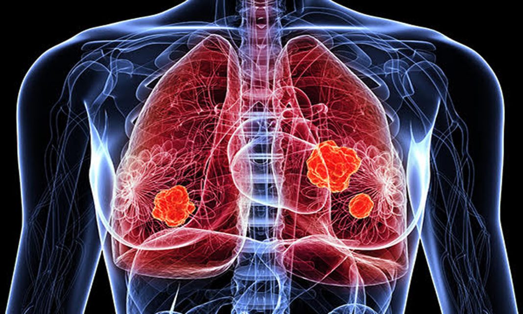 Câncer de pulmão: causas de doenças descobertas em não fumantes. O novo estudo que abre para terapias mais eficazes