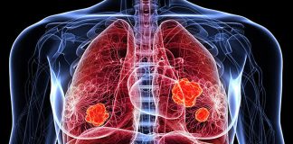 Câncer de pulmão: causas de doenças descobertas em não fumantes. O novo estudo que abre para terapias mais eficazes