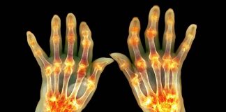 A artrite reumatoide está ligada a um desequilíbrio na microbiota intestinal