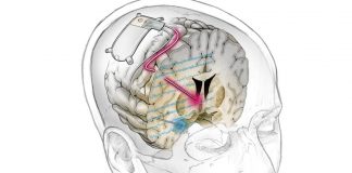 O primeiro implante cerebral do mundo trata com sucesso a depressão resistente em um paciente