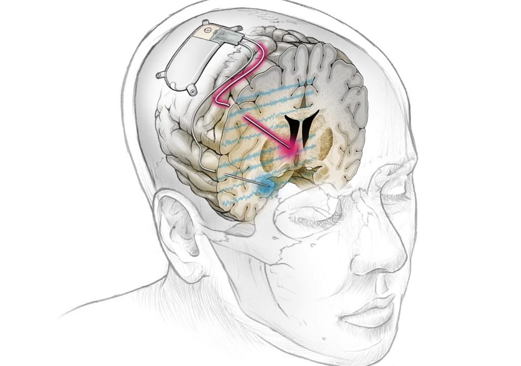 O primeiro implante cerebral do mundo trata com sucesso a depressão resistente em um paciente