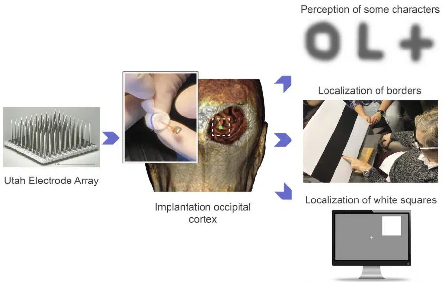 revistasaberesaude.com - Implantes cerebrais permitem que pessoas cegas "vejam" através de uma câmera