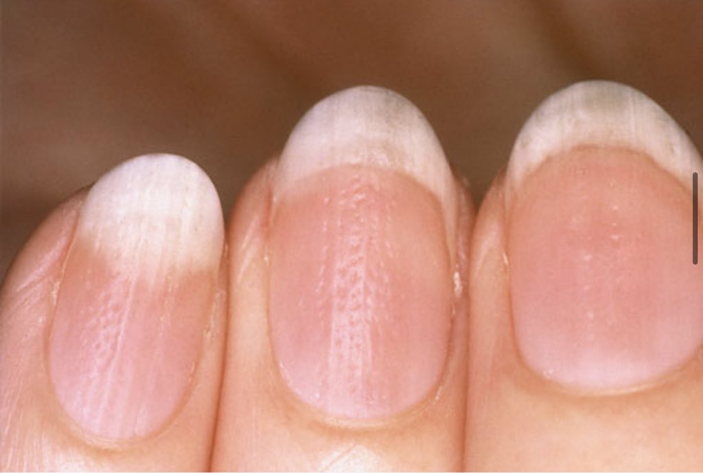 O que suas unhas dizem sobre sua saúde Ew6fFJUXMAEtBPx - O que suas unhas dizem sobre sua saúde