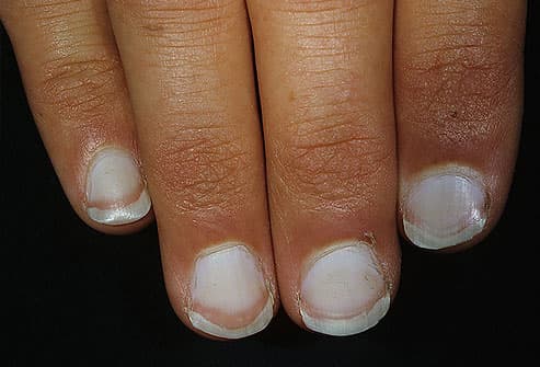 O que suas unhas dizem sobre sua saúde dermnet photo of white nails - O que suas unhas dizem sobre sua saúde