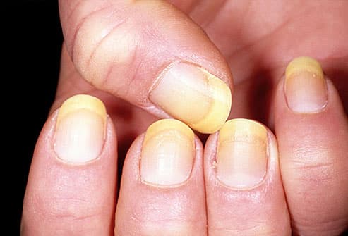 O que suas unhas dizem sobre sua saúde dermnet photo of yellow nails - O que suas unhas dizem sobre sua saúde