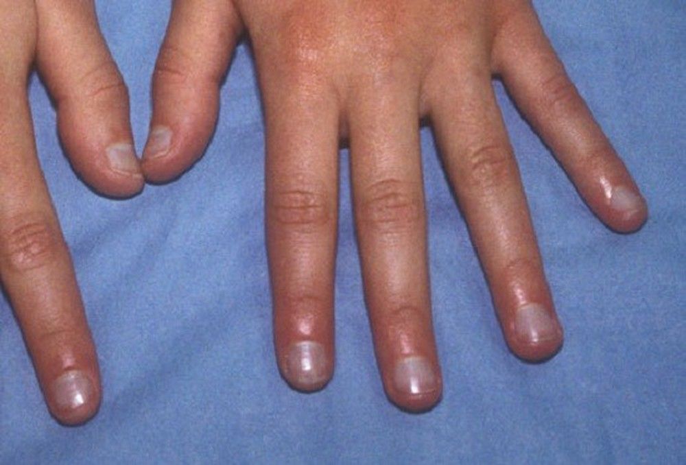 O que suas unhas dizem sobre sua saúde nails 4 f2f6da3ff2f6a2d5c332f1d94d49ec3c - O que suas unhas dizem sobre sua saúde