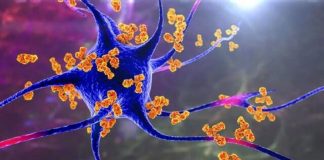 Descoberto o vírus que causa a esclerose múltipla