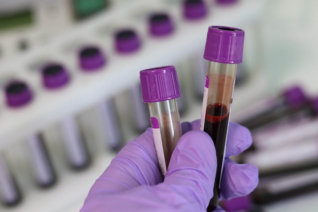 Novo exame de sangue pode detectar câncer e metástases precocemente