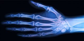 Osteoartrite: tratamento com células-tronco pode regenerar a cartilagem sem a necessidade de cirurgia
