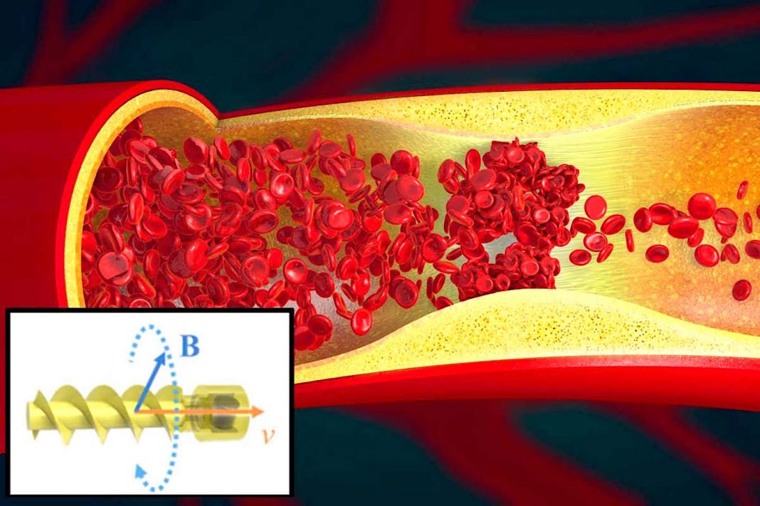Chineses desenvolvem microrrobô em forma de saca-rolhas que nada através dos vasos sanguíneos para limpá-los